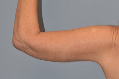 Arm Lift Before & After Gallery - Patient 822132 - Image 2