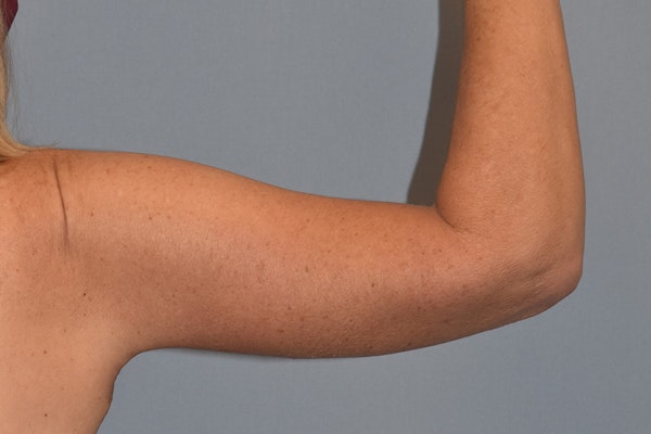 Arm Lift Before & After Gallery - Patient 822132 - Image 6