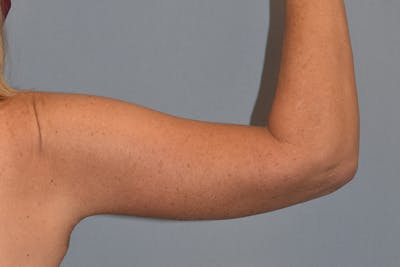 Arm Lift Before & After Gallery - Patient 822132 - Image 6
