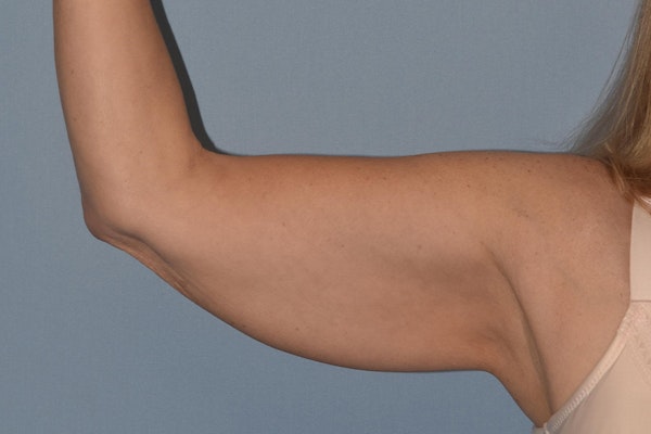 Arm Lift Before & After Gallery - Patient 822132 - Image 3