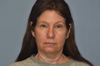 Facelift Before & After Gallery - Patient 277965 - Image 1