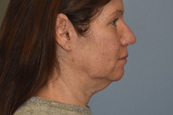 Facelift Before & After Gallery - Patient 277965 - Image 7