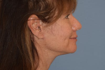 Facelift Before & After Gallery - Patient 277965 - Image 8