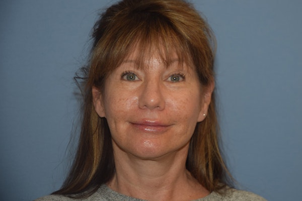 Facelift Before & After Gallery - Patient 277965 - Image 2