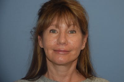 Facelift Before & After Gallery - Patient 277965 - Image 2