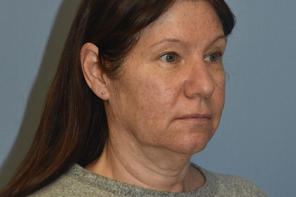 Facelift Before & After Gallery - Patient 277965 - Image 3