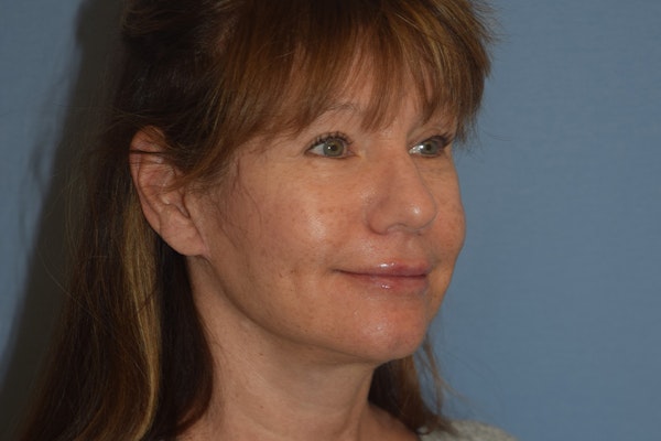 Facelift Before & After Gallery - Patient 277965 - Image 4