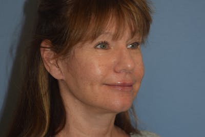 Facelift Before & After Gallery - Patient 277965 - Image 4