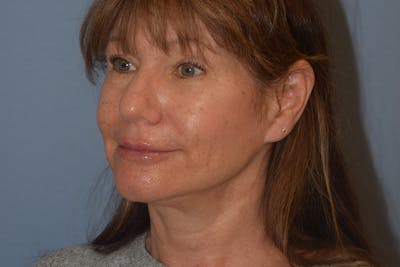 Facelift Before & After Gallery - Patient 277965 - Image 6