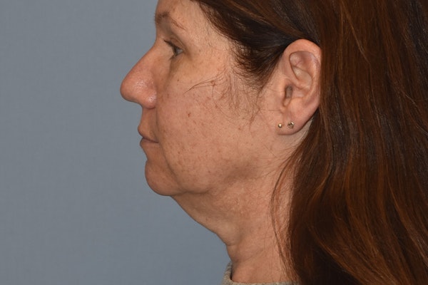 Facelift Before & After Gallery - Patient 277965 - Image 9