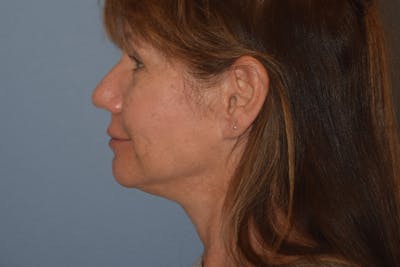 Facelift Before & After Gallery - Patient 277965 - Image 10