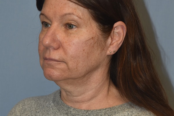 Facelift Before & After Gallery - Patient 277965 - Image 5