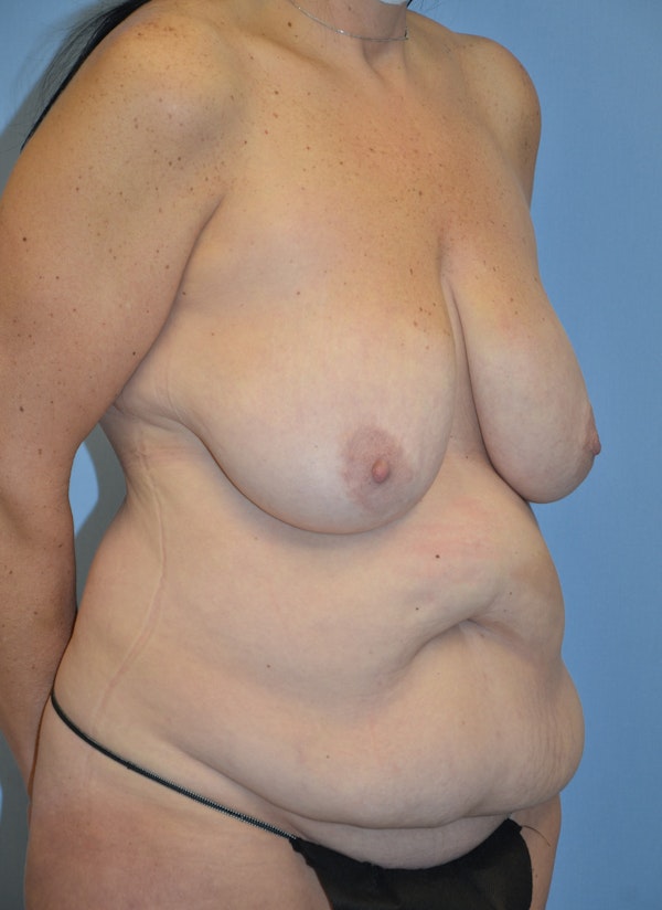 Mommy Makeover Before & After Gallery - Patient 537922 - Image 3