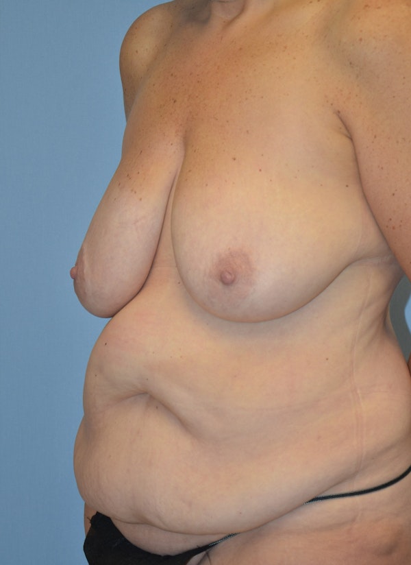 Mommy Makeover Before & After Gallery - Patient 537922 - Image 7