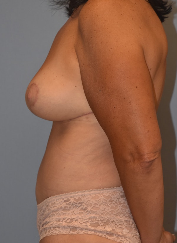 Mommy Makeover Before & After Gallery - Patient 537922 - Image 10