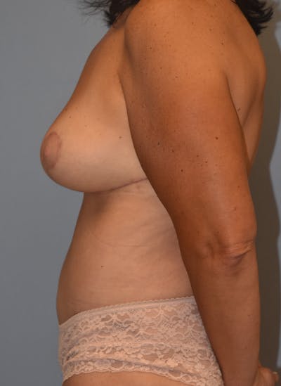 Mommy Makeover Before & After Gallery - Patient 537922 - Image 10