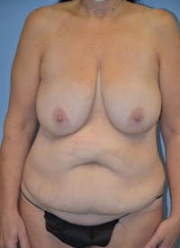 Mommy Makeover Before & After Gallery - Patient 537922 - Image 1