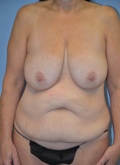 Mommy Makeover Before & After Gallery - Patient 537922 - Image 1
