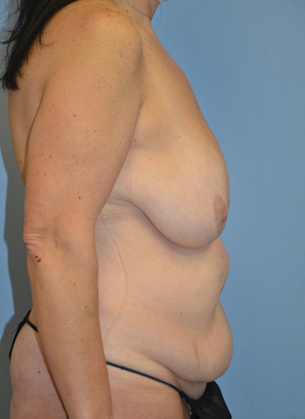 Mommy Makeover Before & After Gallery - Patient 537922 - Image 5