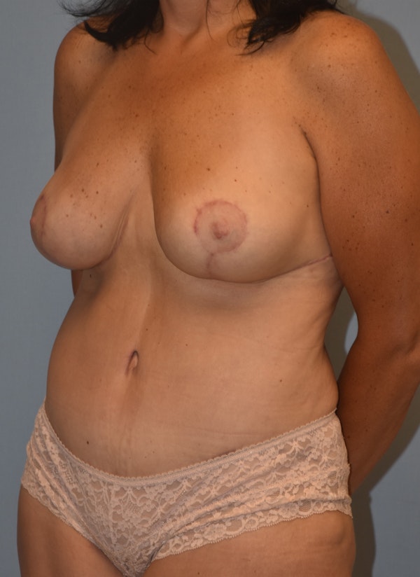 Mommy Makeover Before & After Gallery - Patient 537922 - Image 8