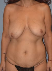Mommy Makeover Before & After Gallery - Patient 314695 - Image 1