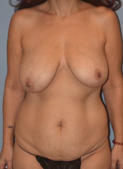 Mommy Makeover Before & After Gallery - Patient 314695 - Image 1