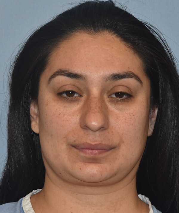 Rhinoplasty Before & After Gallery - Patient 819844 - Image 5