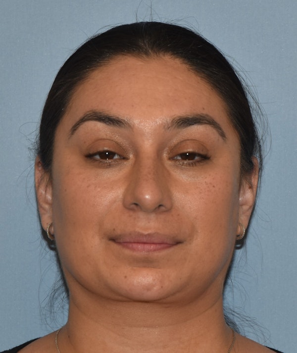 Rhinoplasty Before & After Gallery - Patient 819844 - Image 6