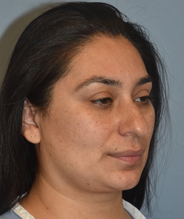Rhinoplasty Before & After Gallery - Patient 819844 - Image 3
