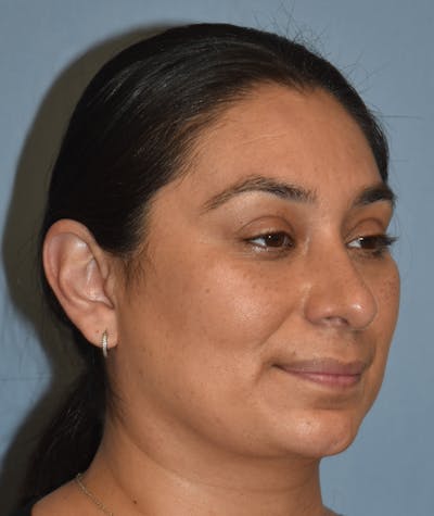 Rhinoplasty Before & After Gallery - Patient 819844 - Image 4