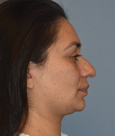Rhinoplasty Before & After Gallery - Patient 819844 - Image 1