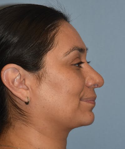 Rhinoplasty Before & After Gallery - Patient 819844 - Image 2