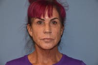 Facelift Before & After Gallery - Patient 244081 - Image 1