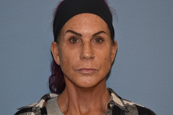 Facelift Before & After Gallery - Patient 244081 - Image 2