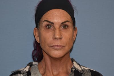 Facelift Before & After Gallery - Patient 244081 - Image 2