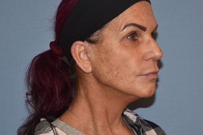 Facelift Before & After Gallery - Patient 244081 - Image 4