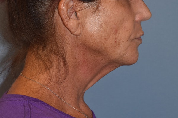 Facelift Before & After Gallery - Patient 244081 - Image 5