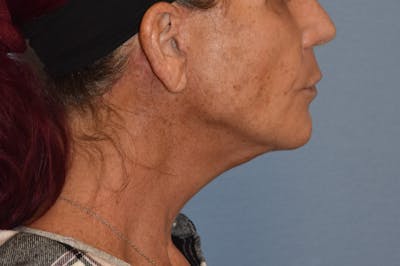 Facelift Before & After Gallery - Patient 244081 - Image 6