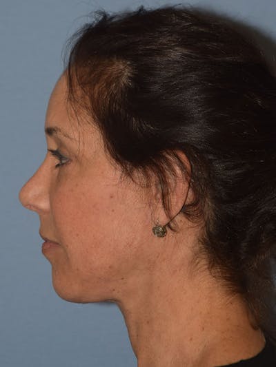 Facelift Before & After Gallery - Patient 310409 - Image 6