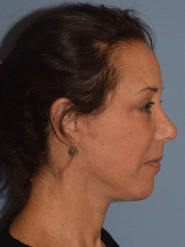 Facelift Before & After Gallery - Patient 310409 - Image 8