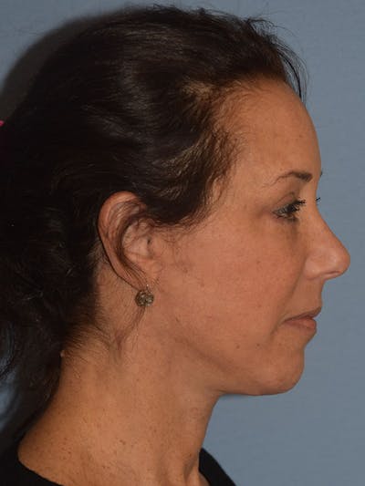 Facelift Before & After Gallery - Patient 310409 - Image 8