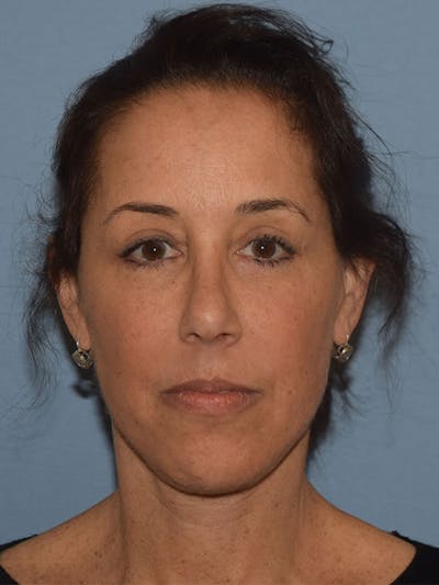 Facelift Before & After Gallery - Patient 310409 - Image 2