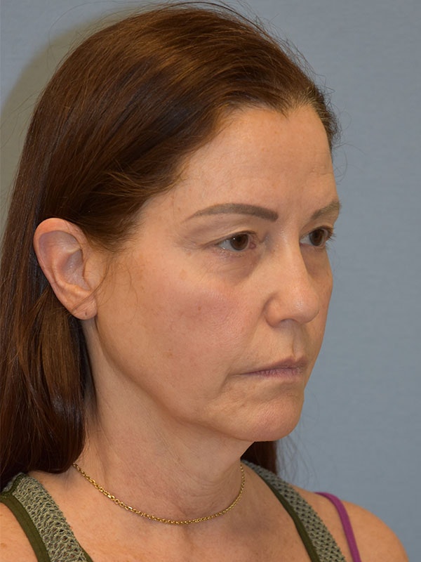 Facelift Before & After Gallery - Patient 539839 - Image 9
