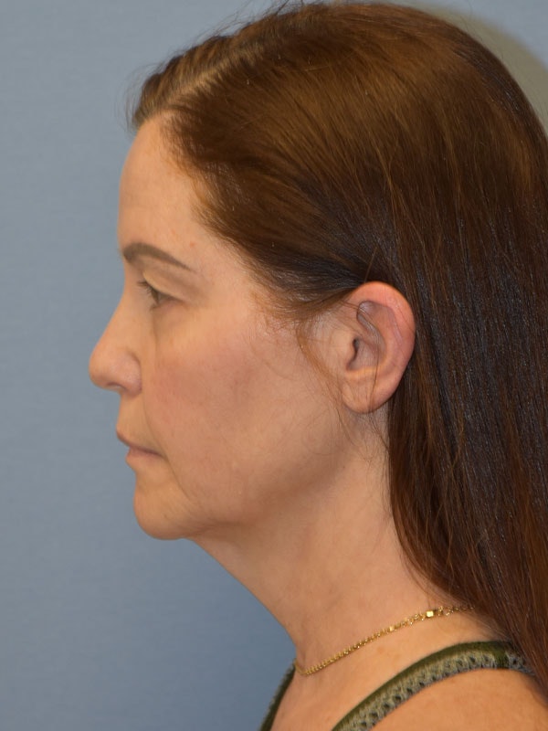 Facelift Before & After Gallery - Patient 539839 - Image 5