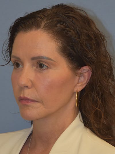 Facelift Before & After Gallery - Patient 539839 - Image 4