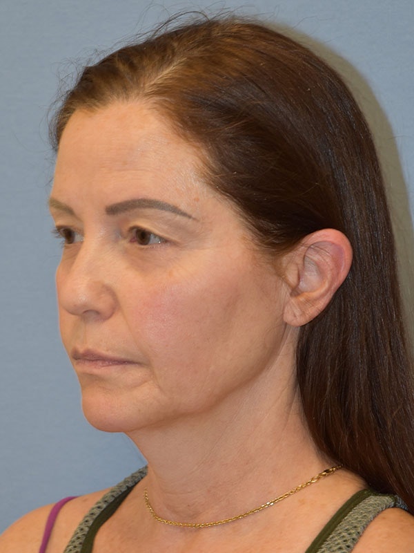 Facelift Before & After Gallery - Patient 539839 - Image 3