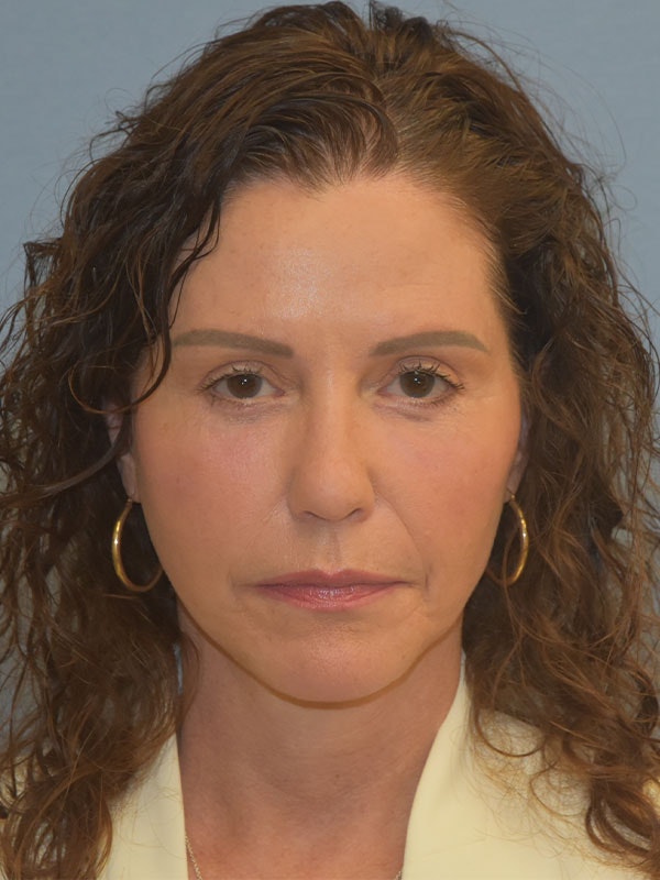 Facelift Before & After Gallery - Patient 539839 - Image 2
