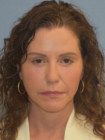 Facelift Before & After Gallery - Patient 539839 - Image 2