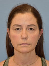 Facelift Before & After Gallery - Patient 539839 - Image 1