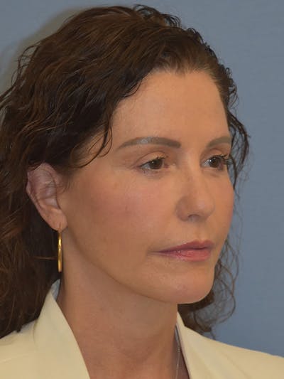 Facelift Before & After Gallery - Patient 539839 - Image 10
